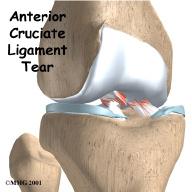 Introduction The anterior cruciate ligament (ACL) is probably the most commonly injured ligament of the knee.
