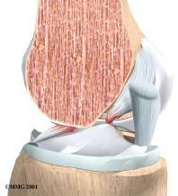 The ACL is located in the center of the knee joint where it runs from the backside of the femur (thighbone) to connect to the front of the tibia (shinbone).