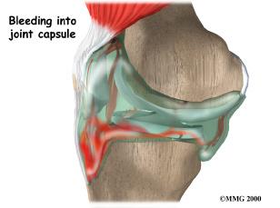The pain and swelling from the initial injury will usually be gone after two to four weeks, but the knee may still feel unstable.