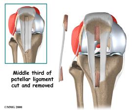 ACL that isn't corrected often leads to early knee arthritis. There is no evidence that an ACL brace will prevent further damage to the knee due to wear and tear arthritis.