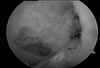 Contra-Lateral Transplant Reference: Paris MJ, Wilcox R, Millett P: Anterior Cuciate Ligament Reconstruction: Surgical Management and Post Operative