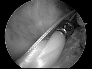 tunnel will impinge against PCL in both flexion and extension
