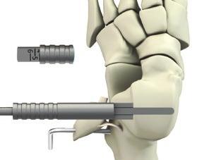 Selection of type of sizer instrument is based on surgeon preference. Insert the Medial/Lateral Sizer Gauge or Sizer between the articular surfaces of the tibia and talus at the top of the talar dome.