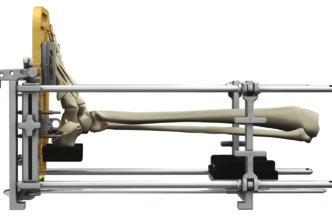 Unlock the four lever fasteners on the U-frame component on the proximal end of the Alignment Stand assembly and slide proximally or distally along