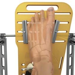 Adjust the Foot Plate Brackets so that they contact the foot at the medial first and lateral fifth metatarsophalangeal (MTP) joints (Fig. 14).