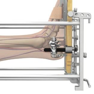 Slide it over the proximal end of the Talar Pin Connector so that the clamp is as close to the foot and is distal to the talar body.