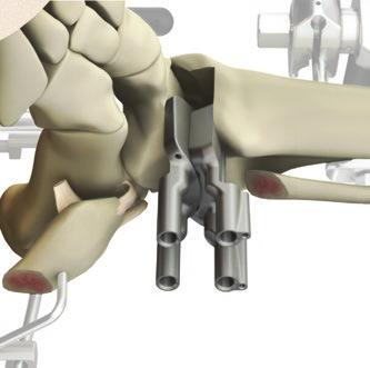 37 Trabecular Metal Total Ankle Surgical Technique Insert Ensure No Lateral Overhang Fig. 66 Fig. 67 Insert and position the Rail Hole Drill Guides into the resected area.