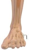 Perform lateral incision and oblique osteotomy of the fibula,