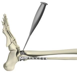As necessary, move the Osteotome medially and repeat the prying motion until the poly lock is fully disengaged.