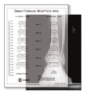 Determine the optimal implant size for the patient (Fig. 1a & 1b). Overlay the sizing templates with both A/P and lateral ankle radiographs of known magnification.