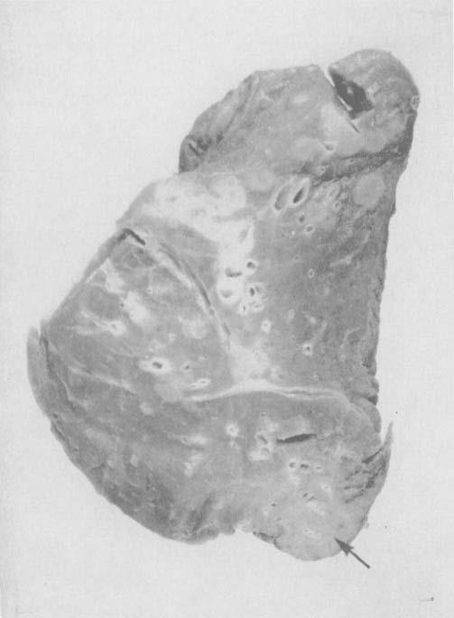 Hodgkin s Disease of Mediastinum FIG. 4. Thymus gland, the normal architecture of which is replaced by nodular sclerosing Hodgkin s disease, illustrated in Figure 2. FIG. 5.