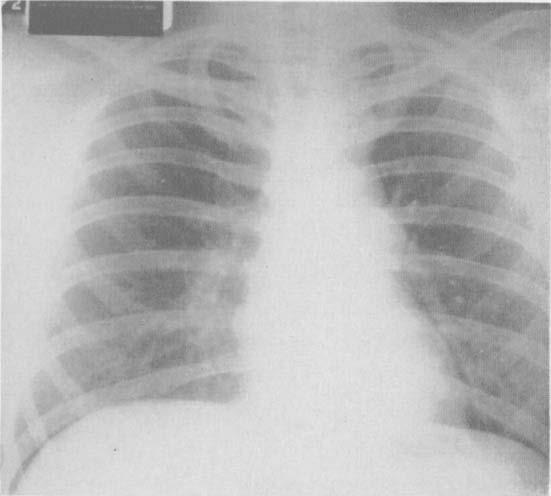 BURKE, BURFORD, AND DORFMAN FIG. 7. X-ray of the chest demonstrating a mediastinal mass. Thoracotomy and biopsy showed Hodgkin s disease involuing lymph nodes.