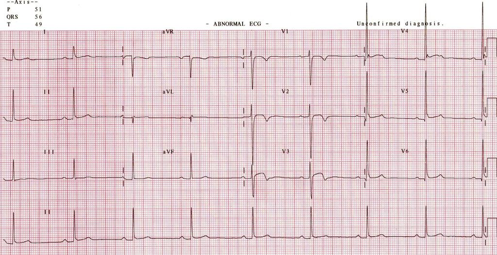 This is the EKG from an asymptomatic 15 year old tennis player.