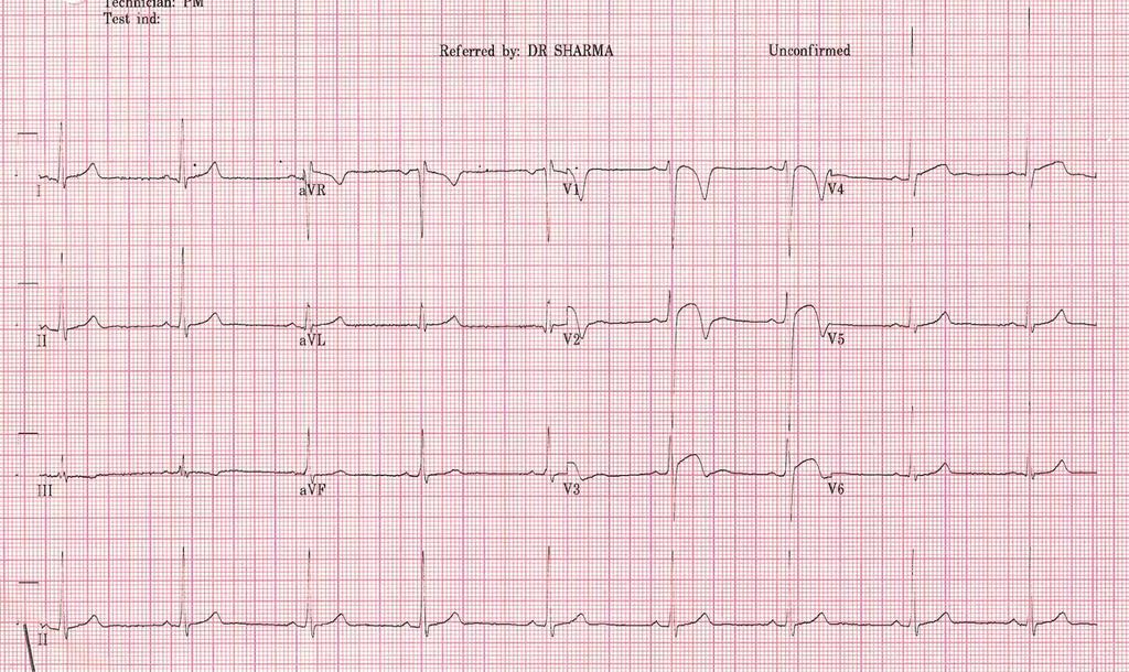 EKG from an Asymptomatic Black