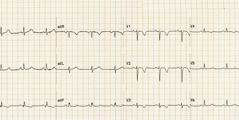 This is the ECG of a 21 year old
