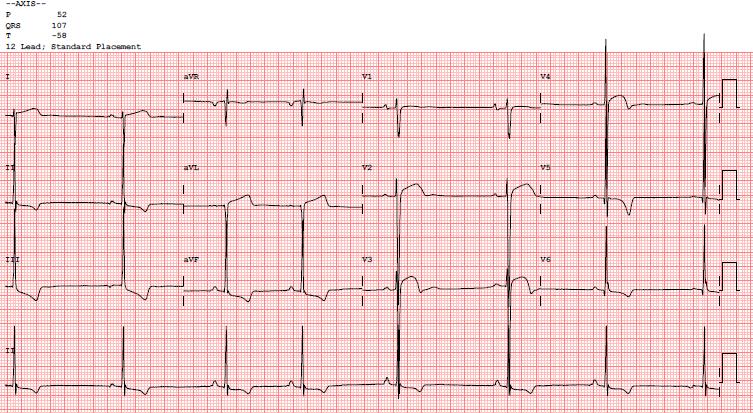 Inferolateral TWI with downsloping