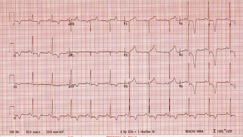 This is the ECG of a 24 year old asymptomatic black basket ball player.