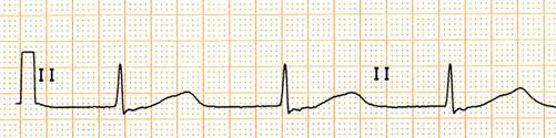 Calculation of the QT interval R 1.