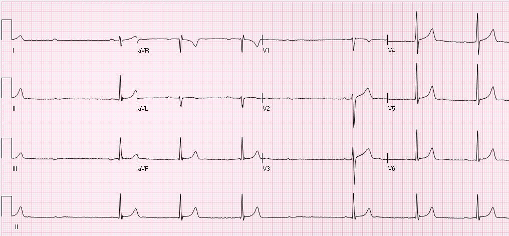 This is an EKG from an