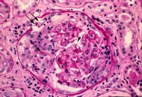 Light Micrographs Normal Glomerulus Crescentic Glomerulonephritis Approach to renal disease Treatment of nephritic diseases with rapid progression, RPGN Steroids.