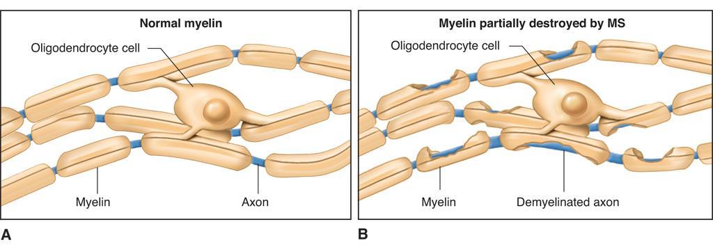 Disorders of nervous tissue Multiple sclerosis Characterized by myelin loss in central nerve fibers and resulting conduction impairments Tumors General