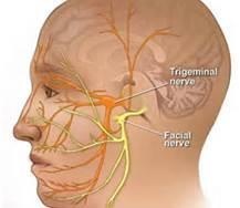 Peripheral Nerve disorders Trigeminal neuralgia - recurring episodes of stabbing pain along one or more branches of the trigeminal