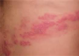 Peripheral Nerve disorders Herpes zoster or shingles Viral infection caused by chickenpox virus that has invaded the dorsal root ganglion