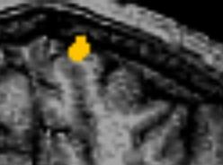 Middle Frontal Gyrus - 8 9-8 9 Awareness x Type L.