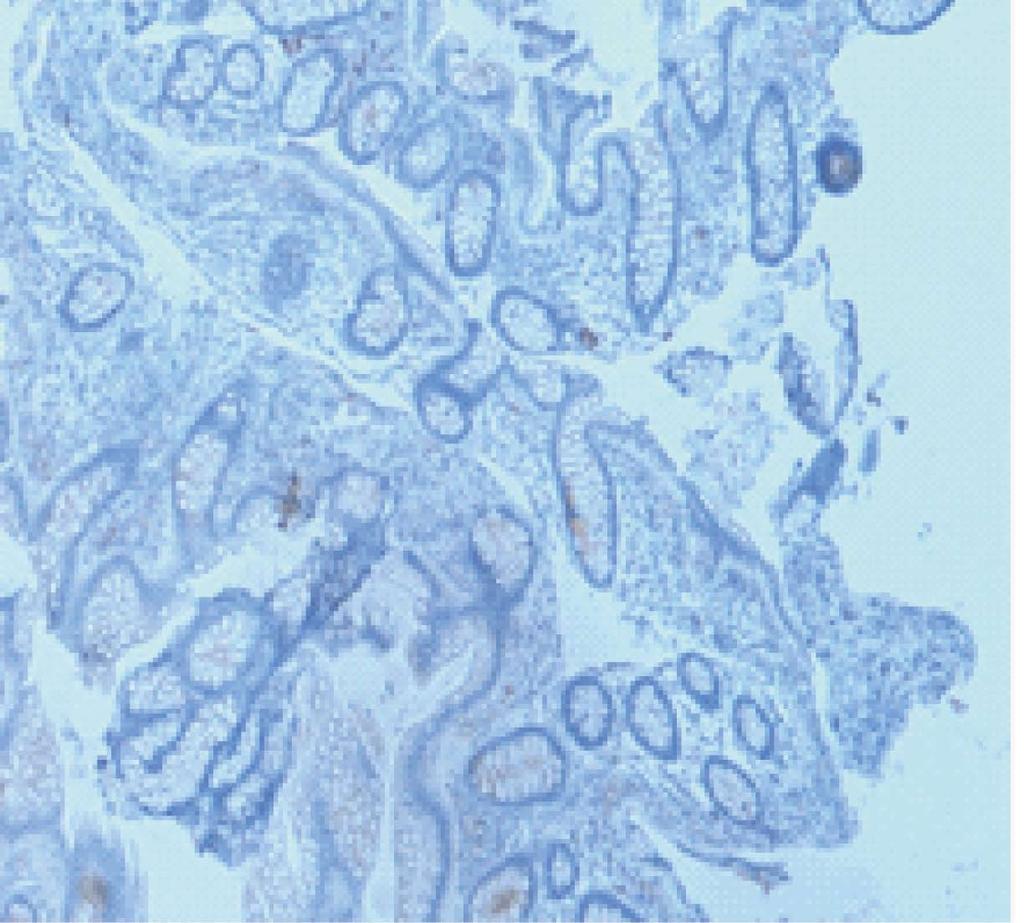 Courtesy of Giancarlo Pompei, personal data. A B Figure 4 Immunohistochemical staining for CD20. An equivalent distribution of B lymphocytes in the lamina propria was seen in the large intestine.