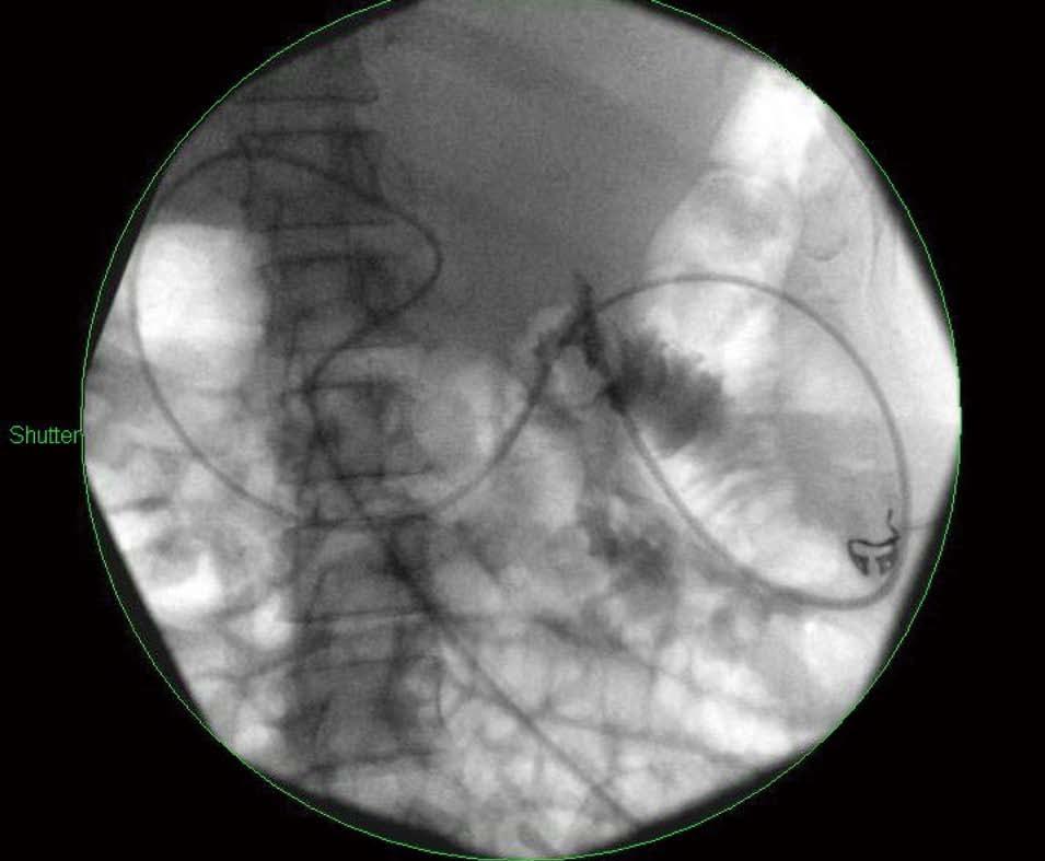 Tyberg A et al. Management of pancreatic fluid collections Shutter Figure 1 Fluoroscopic image of a percutaneous nasojejunal feeding tube beyond the ligament of Treitz.