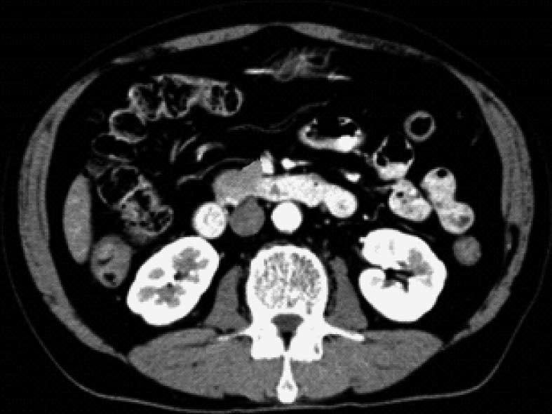 (arrow) and pancreatic body tail (A-C).