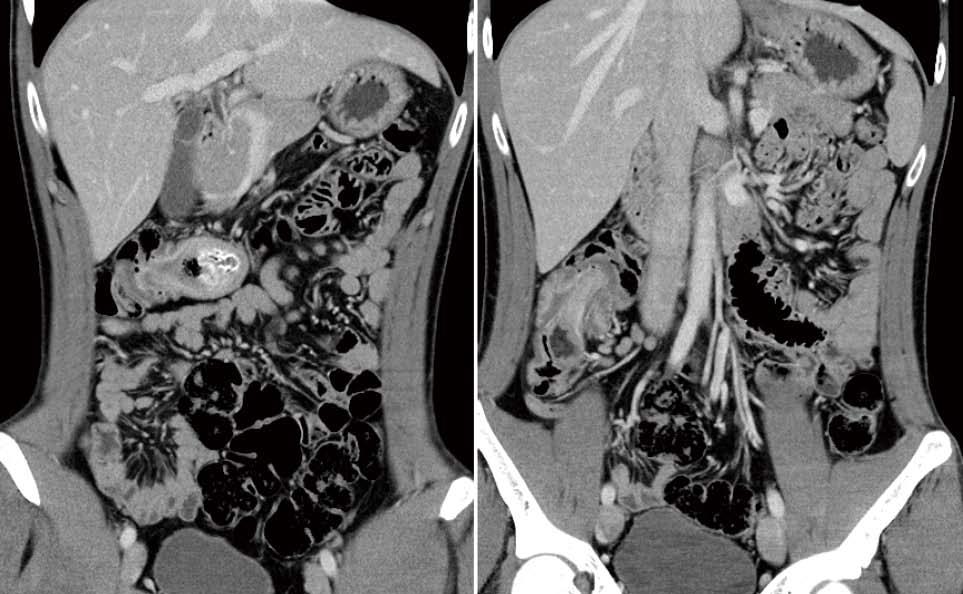 Kyo K et al. Adult colon duplication A B Figure 1 Coronal computed tomography of the abdomen. A: A cystic lesion 4 cm in diameter in the transverse colon (arrow).