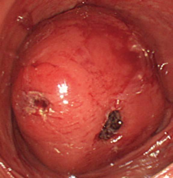 A round mass in the hepatic flexure of the colon (arrow) causing an invagination of the ileocecal region into the ascending colon (arrowhead).