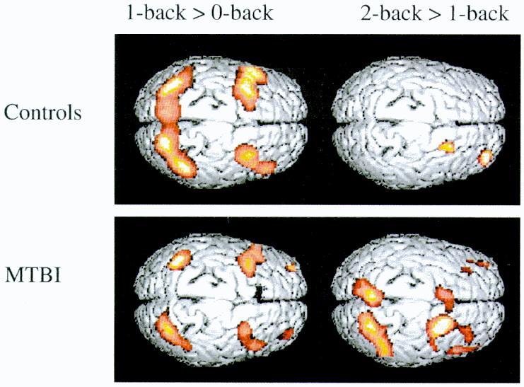 Working memory task shows increased cerebral blood flow across a wider cortical area than controls,