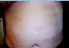 Early Disseminated Disease (weeks to months) Cutaneous Manifestations EM at sites other than the original bite Neurologic (15% of UNTREATED patients) Lymphocytic meningitis