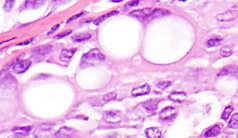 within Collagenous Spherulosis Key clues: Hyaline ring