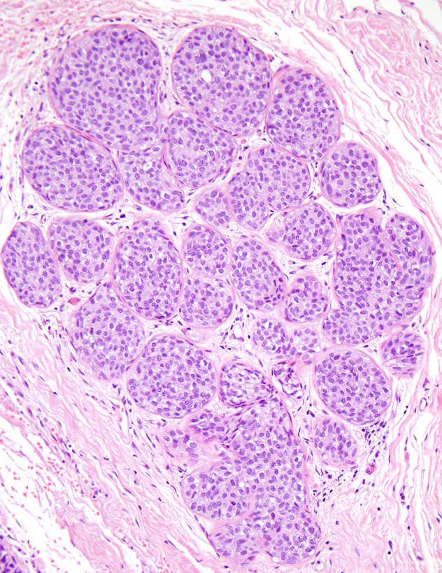 Solid Pattern In Situ Carcinoma when it s too packed to