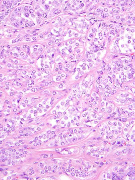 LCIS in sclerosing adenosis may
