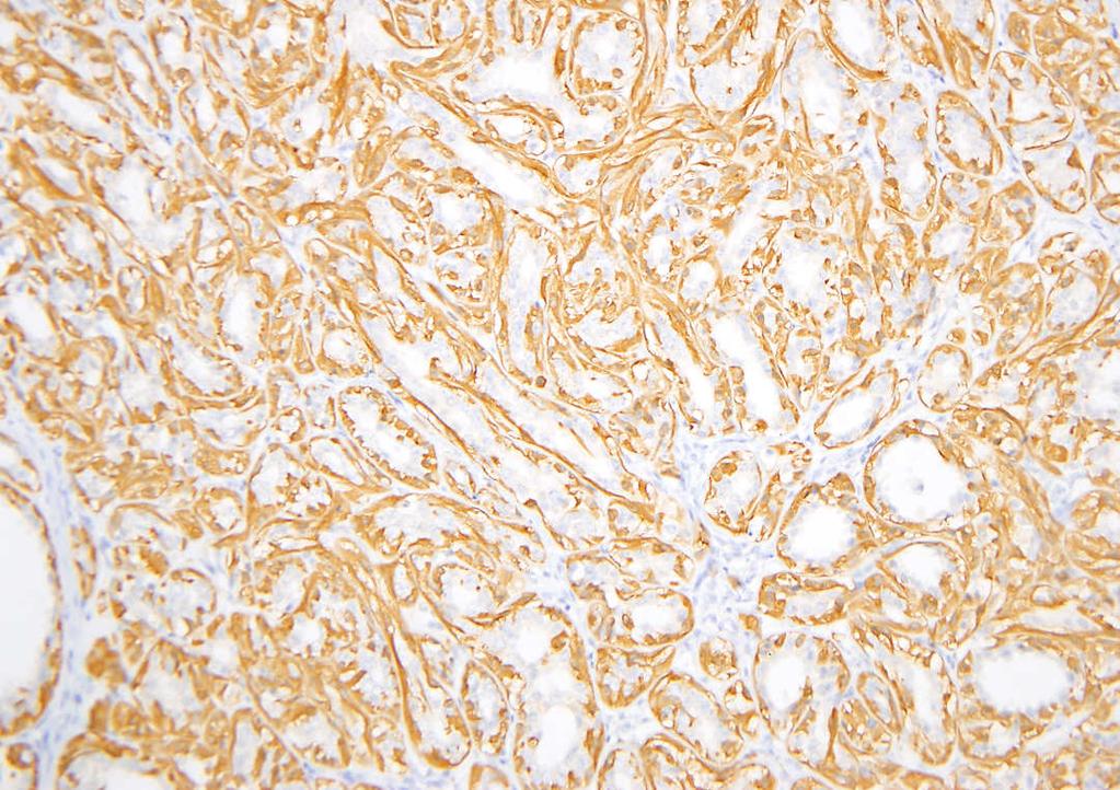 Florid LCIS in sclerosing adenosis mimics invasive cancer Recommendation: Calponin Presence of nearby sclerosing adenosis