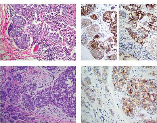 Aberrant E-cadherin partial loss in ductal carcinoma Interpreting E-cadherin Defects in E-cadherin gene can cause: Loss of protein absent immunostaining Loss of function aberrant immunostaining Choi