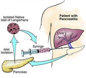 Pancreas completely removed (TP) Islet cells (insulin producing) separated from specimen Islet cells given back