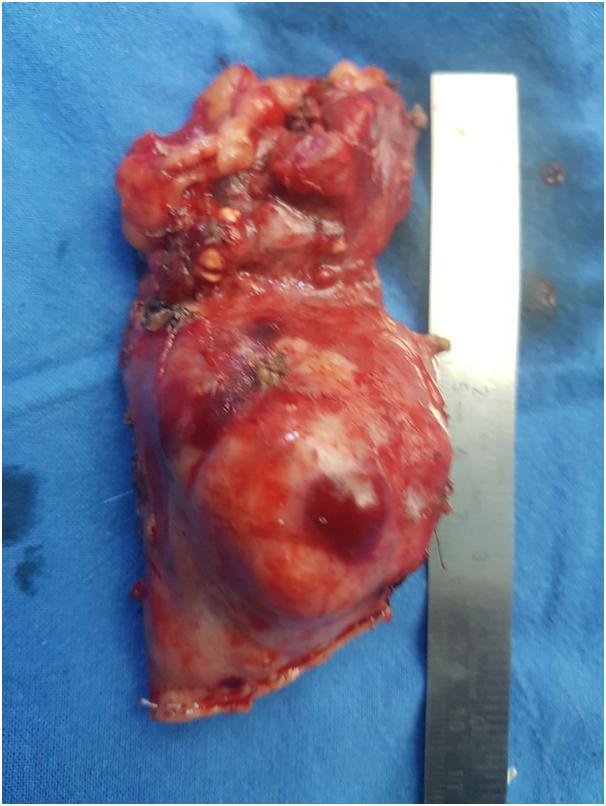 The patient underwent distal pancreatectomy with splenectomy of the pancreatic mass 4* 3.4*3.7 cm in size(fig 4).