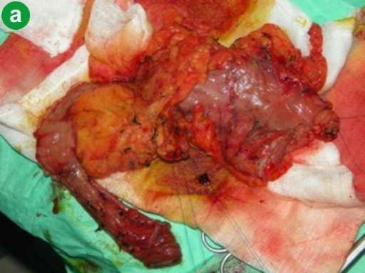 There was never any evidence of cystic lesions or dilated ducts. The patient was treated conservatively. One year later he underwent a cholecystectomy after a similar episode of pancreatitis.