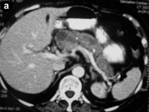Metastatic deposits were found in three peripancreatic lymph nodes. Figure 2. Radiological, intraoperative and histological findings of Case #2. a. Abdominal computed tomography showed nonhomogeneous cystic mass in the head of pancreas.