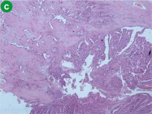 Histological slide showing cystic areas with IPMN features and adjacent solid areas with multiple glands and tubules resembling usual ductal adenocarcinoma.