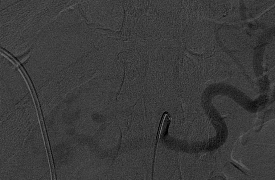 CELIAC ANGIOGRAM Celiac angiogram with a large
