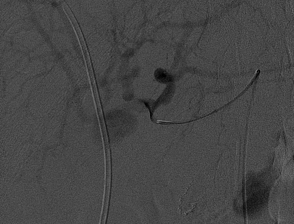 COMMON HEPATIC ANGIOGRAM Common hepatic angiogram with a large pseudoaneurysm originating from the right hepatic artery (arrow) Note