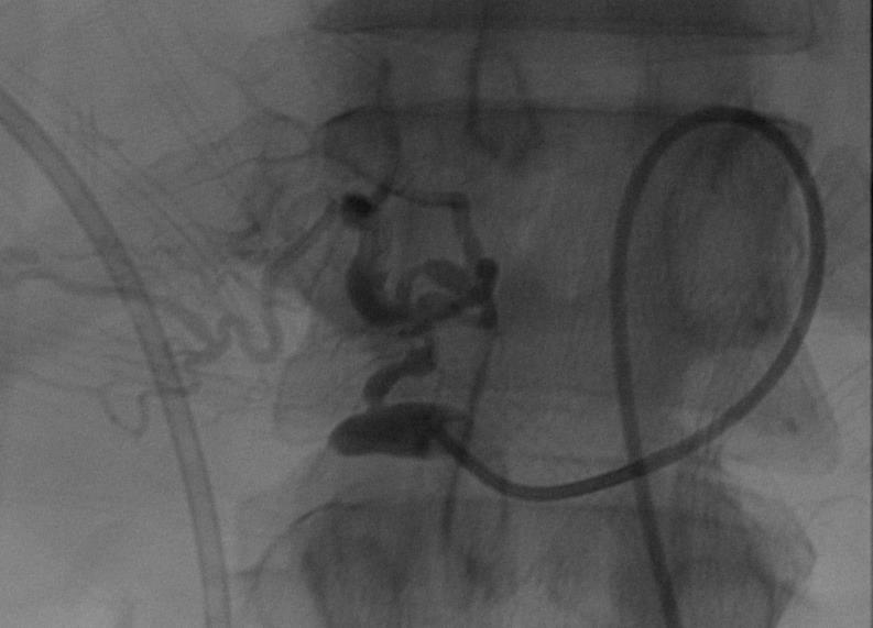 RIGHT HEPATIC ANGIOGRAM There are two branches of the right hepatic artery