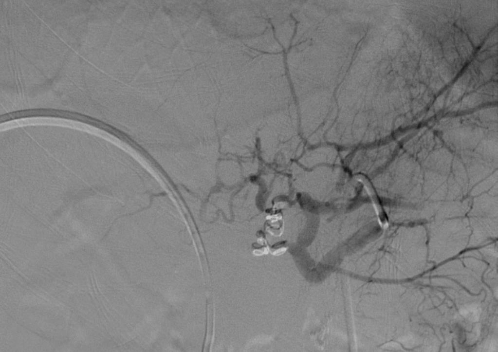 RIGHT HEPATIC ARTERY COILING Coil embolization with occlusion of the right hepatic artery Reconstitution of