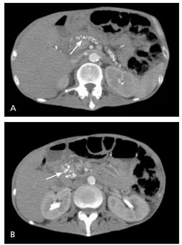 Diagnosis Chronic Pancreatitis: Pancreatic Calcifications Contrast-enhanced computed tomography of the upper abdomen showing (A) pancreatic calcifications (arrow) with